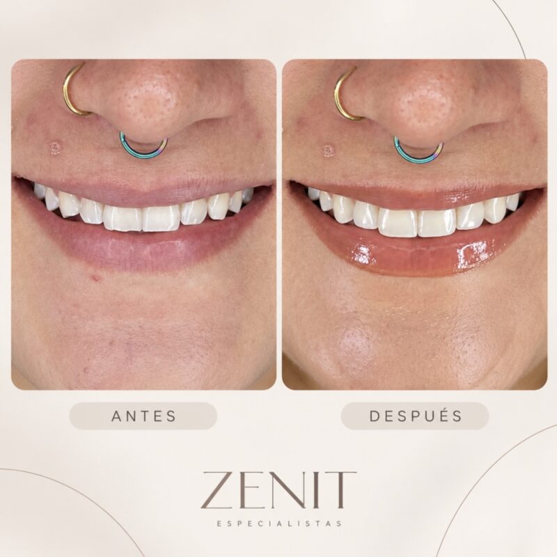 Antes y después: diseño de sonrisa
